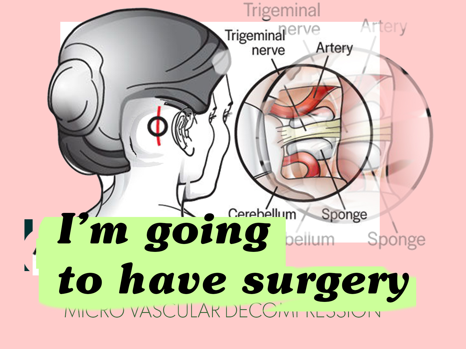 Going to have micro vascular decompression surgery (MVD)